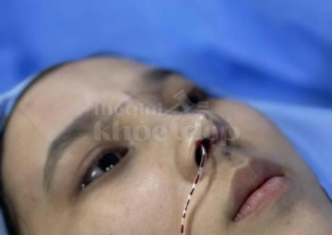 Nâng mũi đẹp tự nhiên, an toàn – Giải pháp hoàn hảo từ bác sĩ uy tín - 4/4