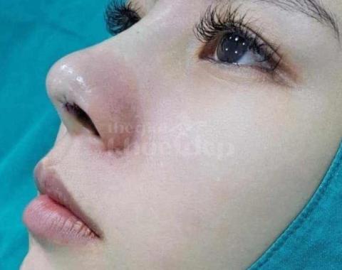 Nâng mũi đẹp tự nhiên chuẩn bác sĩ – An toàn, hiệu quả, giá ưu đãi - 1/3