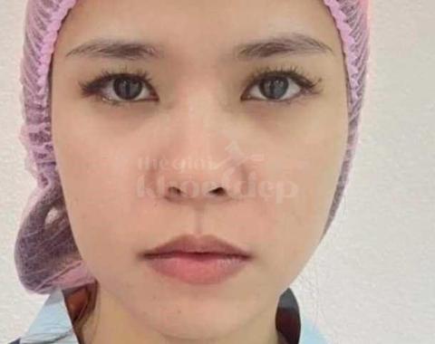 Nâng mũi đẹp tự nhiên chuẩn bác sĩ – An toàn, hiệu quả, giá ưu đãi - 2/3