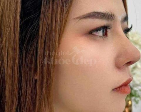 Nâng mũi đẹp tự nhiên chuẩn bác sĩ – An toàn, hiệu quả, giá ưu đãi - 3/3