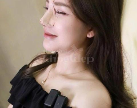 Nâng mũi S-line chuẩn Hàn – Tự nhiên, cân đối, an toàn tối đa - 1/4