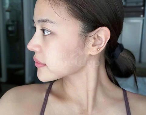 Nâng mũi S-line chuẩn Hàn – Tự nhiên, cân đối, an toàn tối đa - 2/4