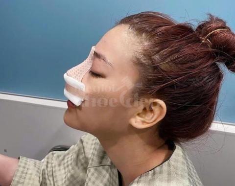 Nâng mũi S-line chuẩn Hàn – Tự nhiên, cân đối, an toàn tối đa - 3/4