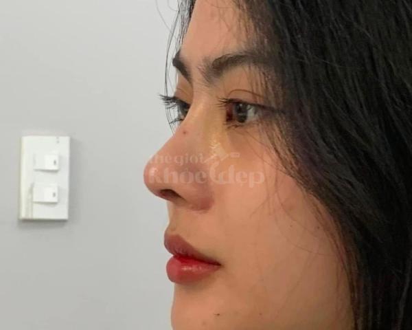 Nâng mũi cấu trúc Hàn Quốc – Dáng mũi thon gọn, thanh tú, chuẩn tỷ lệ vàng - 1/5