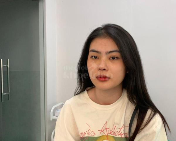 Nâng mũi cấu trúc Hàn Quốc – Dáng mũi thon gọn, thanh tú, chuẩn tỷ lệ vàng - 3/5