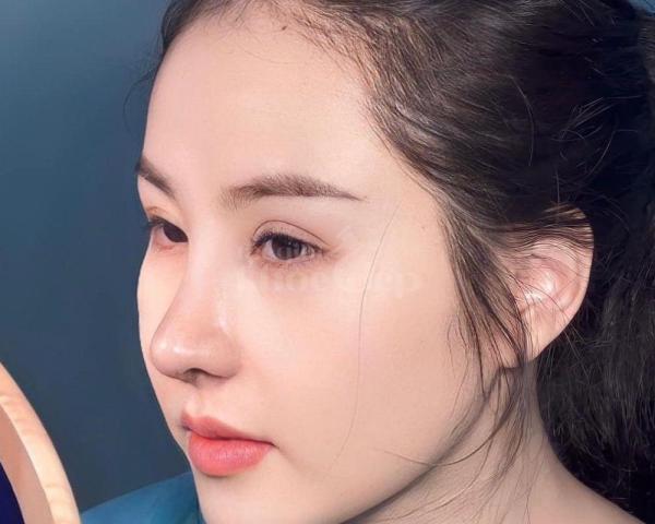 Nâng mũi S-line Ultimate – Sống mũi cao, đầu mũi thanh thoát, gương mặt hài hòa - 3/5