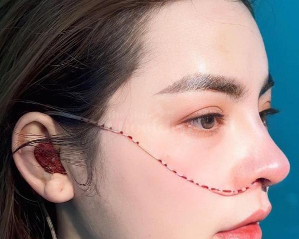 “Nâng mũi đẹp tự nhiên – An toàn tuyệt đối, giá ưu đãi trên thegioikhoedep.com” - 1/7