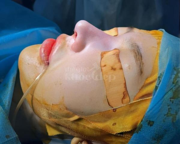 “Nâng mũi đẹp tự nhiên – An toàn tuyệt đối, giá ưu đãi trên thegioikhoedep.com” - 4/7