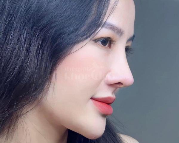 “Nâng mũi đẹp tự nhiên – An toàn tuyệt đối, giá ưu đãi trên thegioikhoedep.com” - 5/7