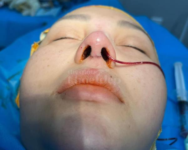 “Nâng mũi đẹp tự nhiên – An toàn tuyệt đối, giá ưu đãi trên thegioikhoedep.com” - 6/7