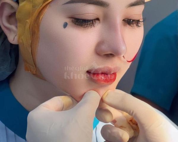 Nâng mũi cấu trúc 4D tự nhiên, an toàn, duy trì bền lâu — thegioikhoedep.com - 5/7