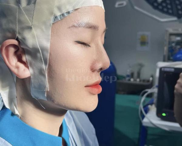 Nâng mũi cấu trúc 4D tự nhiên, an toàn, duy trì bền lâu — thegioikhoedep.com - 6/7