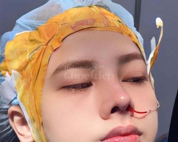 Nâng mũi 4D cấu trúc chuẩn y khoa – Dáng mũi cao tự nhiên, đẹp bền lâu - 1/7