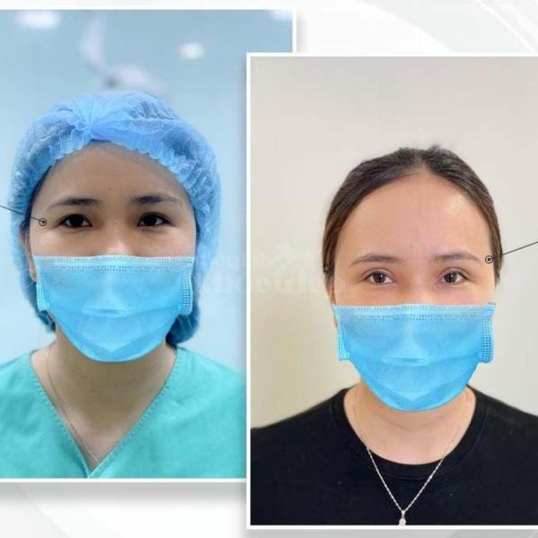 Cắt mí Eyelid Design Hàn Quốc – Công nghệ mí tự nhiên, đẹp bền lâu - 1/4