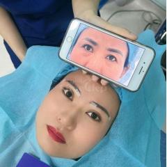 Cắt mí mắt xoá bọng, loại bỏ da chùng, khắc phục mắt buồn
