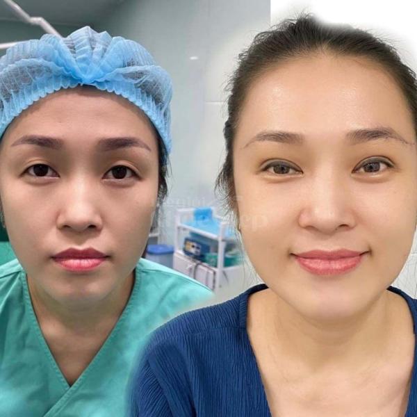 Cắt mí mắt xoá bọng, loại bỏ da chùng, khắc phục mắt buồn - 2/4