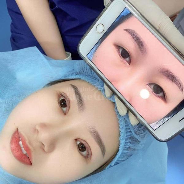 Cắt mí mắt xoá bọng, loại bỏ da chùng, khắc phục mắt buồn - 3/4