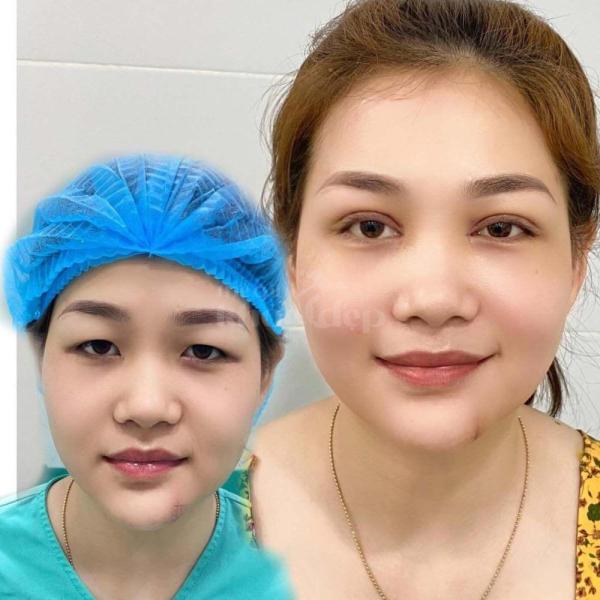 Cắt mí mắt xoá bọng, loại bỏ da chùng, khắc phục mắt buồn - 4/4