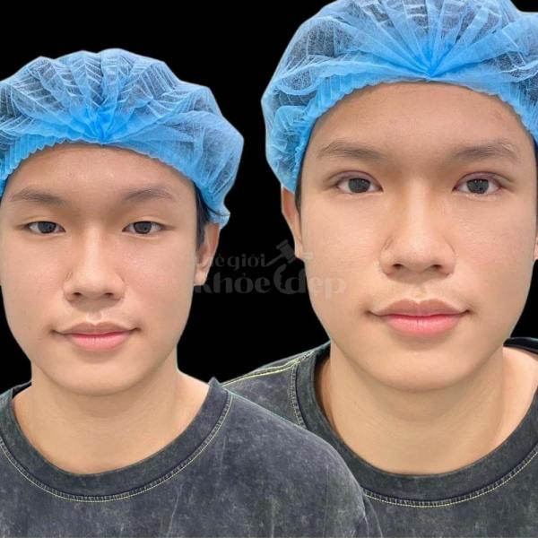 Cắt mí Plasma xoá bọng, da chùng, khâu giấu chỉ siêu mảnh – Cho đôi mắt tự nhiên, không lộ thẩm mỹ. - 3/4