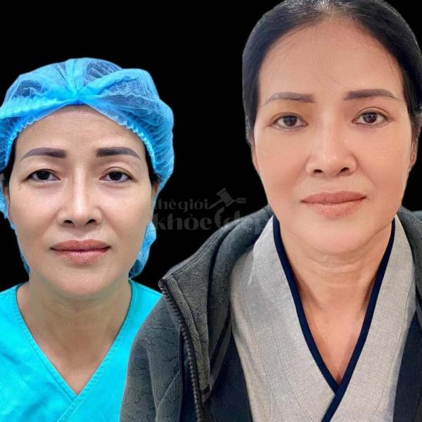 Nhấn mí Mini Deep – Công nghệ mới cho đôi mắt 2 mí đẹp chuẩn tự nhiên, không phẫu thuật, không để lạ - 1/4