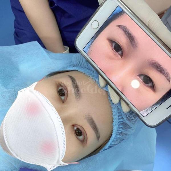 Nhấn mí Mini Deep – Công nghệ mới cho đôi mắt 2 mí đẹp chuẩn tự nhiên, không phẫu thuật, không để lạ - 2/4