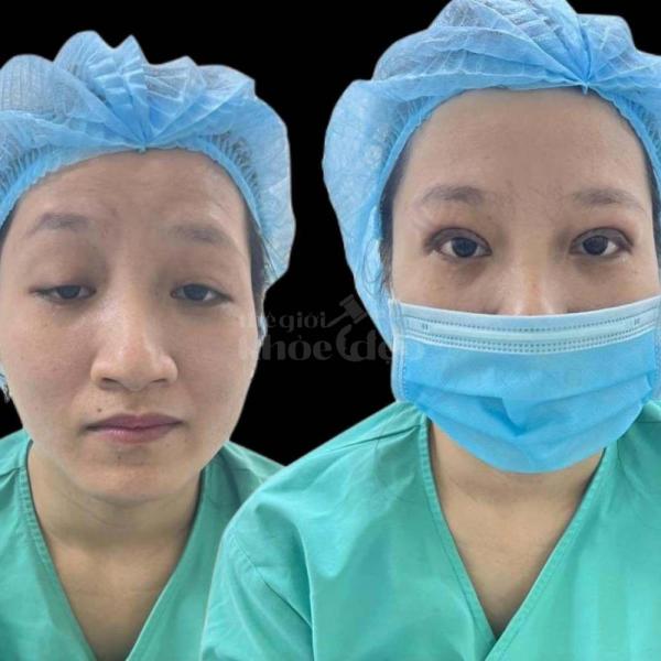 Nhấn mí Mini Deep – Công nghệ mới cho đôi mắt 2 mí đẹp chuẩn tự nhiên, không phẫu thuật, không để lạ - 3/4