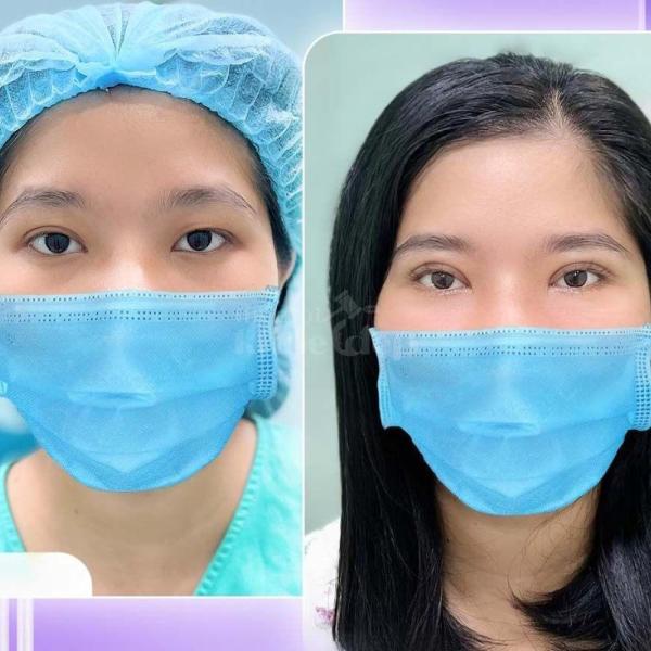 Nhấn mí Mini Deep – Công nghệ mới cho đôi mắt 2 mí đẹp chuẩn tự nhiên, không phẫu thuật, không để lạ - 4/4