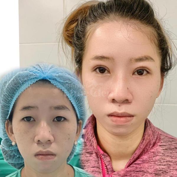 Cắt mí Hàn Quốc công nghệ mới – Khắc phục mắt 1 mí, sụp mí, da chùng, cho ánh nhìn rạng ngời tự nhiê - 2/4