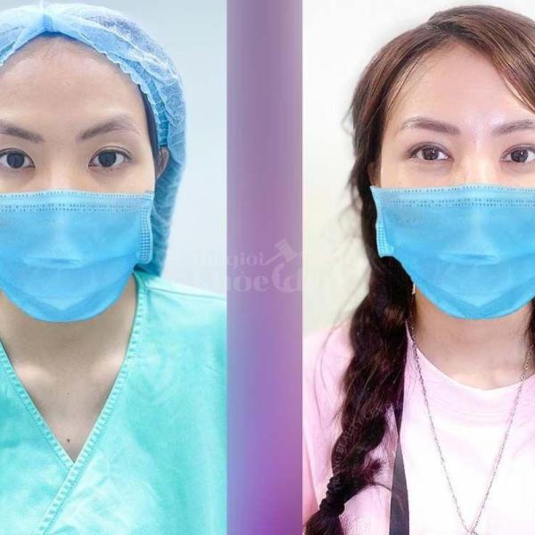 Combo Cắt mí + Nhấn mí Mini Deep – Trẻ hóa, xoá sụp mí, cho mắt 2 mí rõ tự nhiên và bền lâu. - 3/4