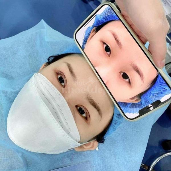 Combo Cắt mí + Nhấn mí Mini Deep – Trẻ hóa, xoá sụp mí, cho mắt 2 mí rõ tự nhiên và bền lâu. - 4/4