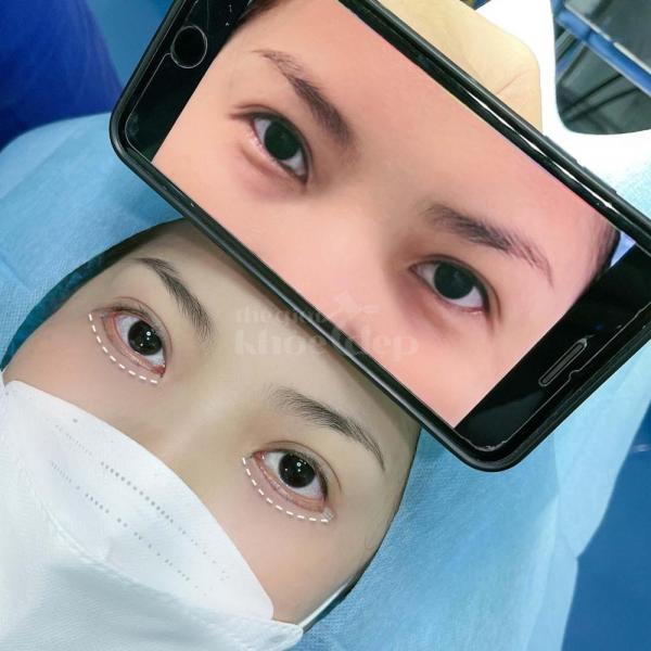 Cắt mắt 2 mí Mini Deep – Công nghệ tạo mí đẹp tự nhiên, an toàn - 4/4
