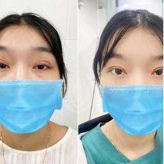 Cắt mí Plasma: Xóa bỏ da chùng, mở to đôi mắt, trẻ hóa toàn diện chỉ sau 1 lần thực hiện.