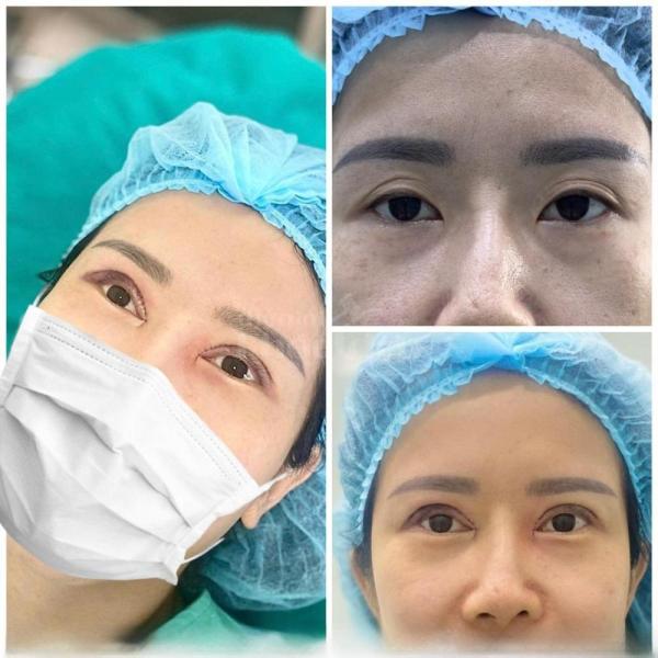 Cắt mí Mini Deep – Tạo đôi mắt hai mí sâu tự nhiên, đẹp bền lâu - 2/5