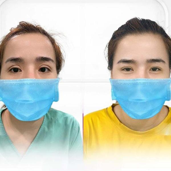 Cắt mí Mini Deep – Tạo đôi mắt hai mí sâu tự nhiên, đẹp bền lâu - 5/5