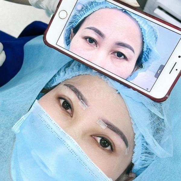 Cắt mí Mini Deep tạo nếp mí 2 mí rõ nét, tự nhiên và bền lâu - 2/4