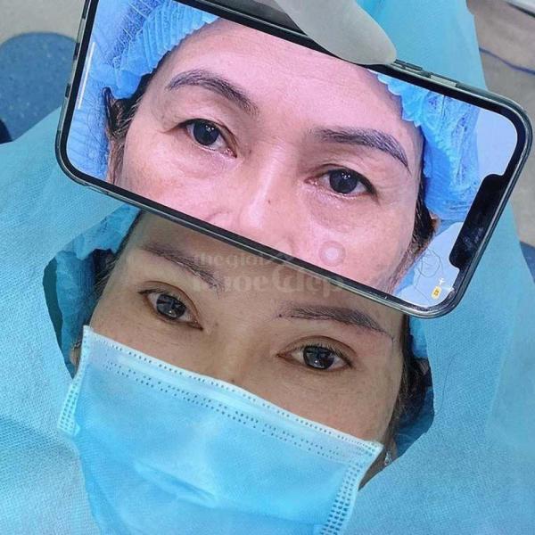 Cắt mí Mini Deep tạo nếp mí 2 mí rõ nét, tự nhiên và bền lâu - 3/4