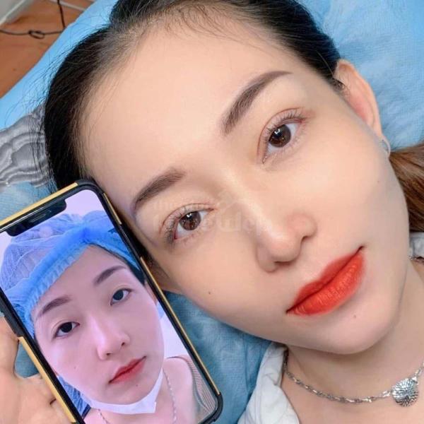 Cắt mí Mini Deep tạo nếp mí 2 mí rõ nét, tự nhiên và bền lâu - 4/4