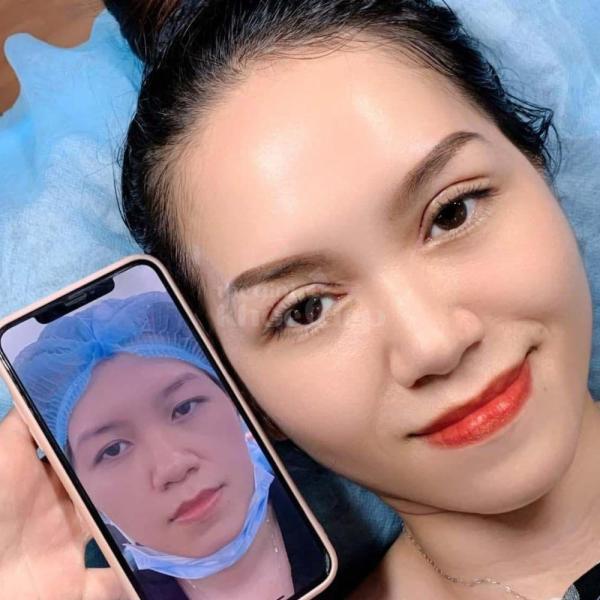 Cắt mí Mini Deep giải pháp tạo nếp mí 2 mí rõ nét, trẻ trung tự nhiên - 2/4