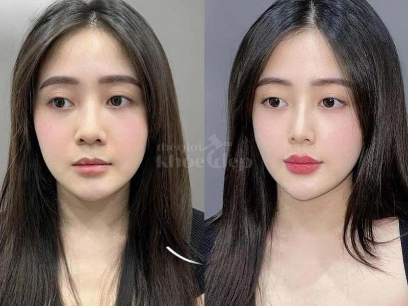 Tiêm má baby căng mịn, tự nhiên, trẻ trung – An toàn chuẩn bác sĩ - 2/4