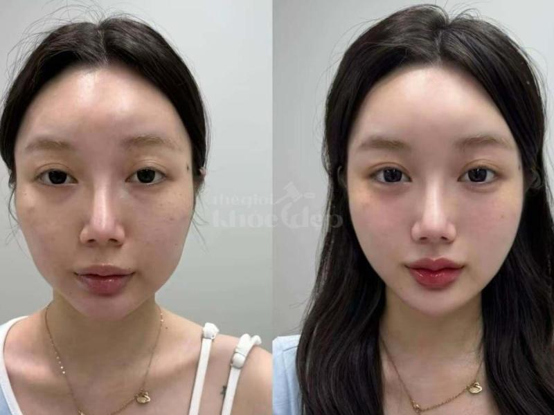 Tiêm má Baby – Giải pháp trẻ hóa gương mặt tự nhiên, bầu má căng đầy, duy trì lâu dài - 1/4