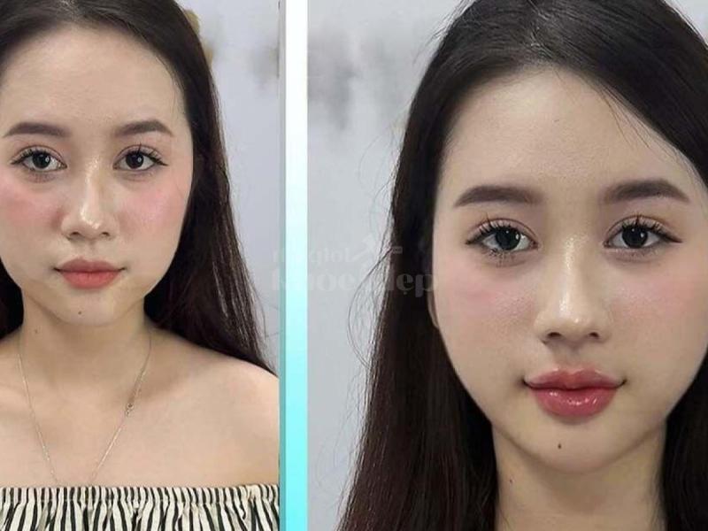 Tiêm má Baby – Giải pháp trẻ hóa gương mặt tự nhiên, bầu má căng đầy, duy trì lâu dài - 2/4