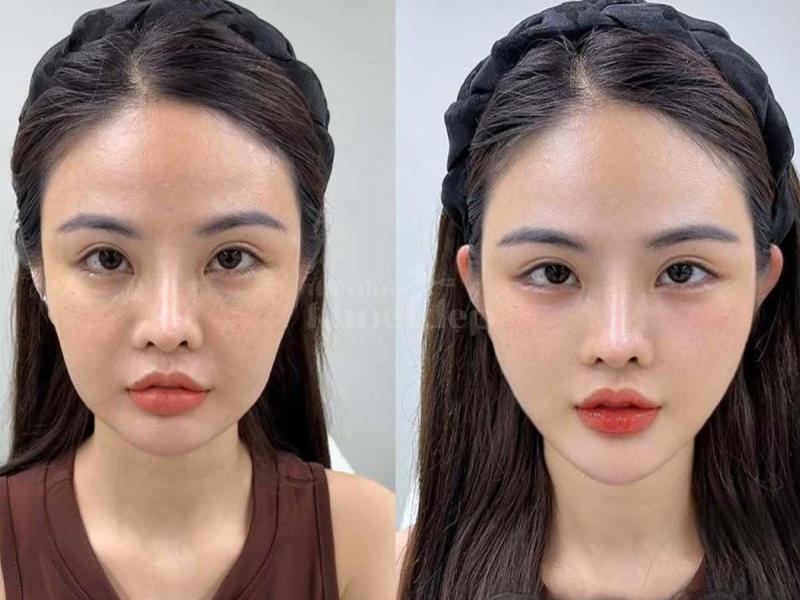 Tiêm má Baby – Giải pháp trẻ hóa gương mặt tự nhiên, bầu má căng đầy, duy trì lâu dài - 3/4