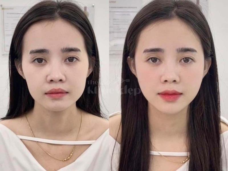 Tiêm má Baby tại Hồ Chí Minh – Gương mặt đầy đặn, trẻ trung, cân đối tự nhiên - 2/4