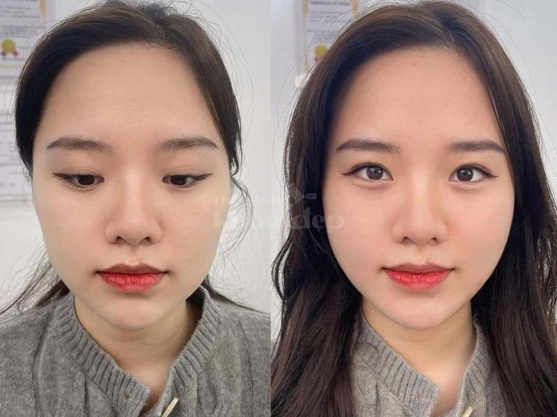 Tiêm má Baby tại Hồ Chí Minh – Gương mặt đầy đặn, trẻ trung, cân đối tự nhiên - 4/4