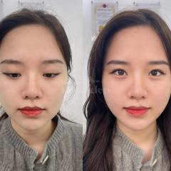 Tiêm Filler Thái Dương – Giải pháp khắc phục hõm thái dương, trẻ hóa gương mặt