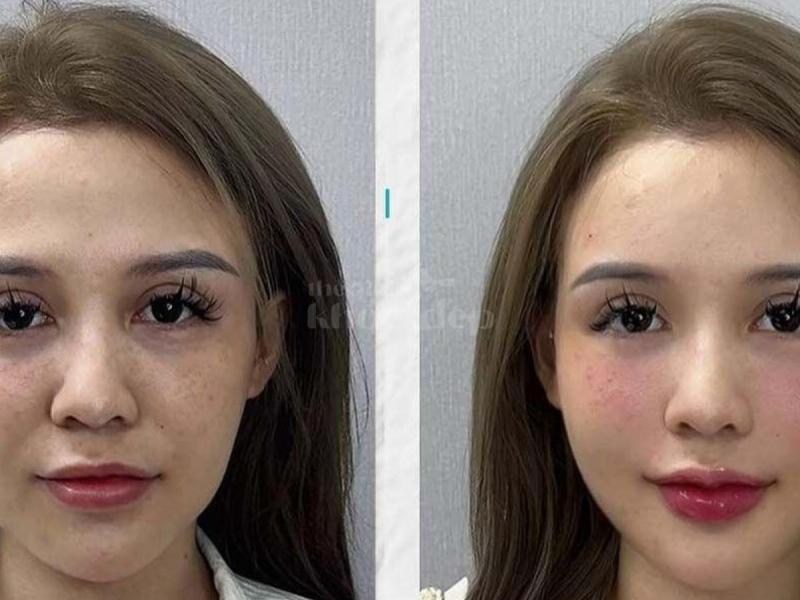 Tiêm má baby – Giải pháp làm đầy má hóp, trẻ hóa gương mặt, an toàn tự nhiên - 4/4