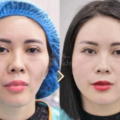 Tiêm má Baby – Giải pháp trẻ hóa gương mặt, khắc phục hóp má, mang lại nét đẹp căng đầy tự nhiên