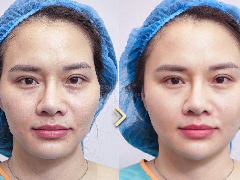 Tiêm má Baby – Giải pháp trẻ hóa gương mặt, khắc phục hóp má, mang lại nét đẹp căng đầy tự nhiên - 2/4