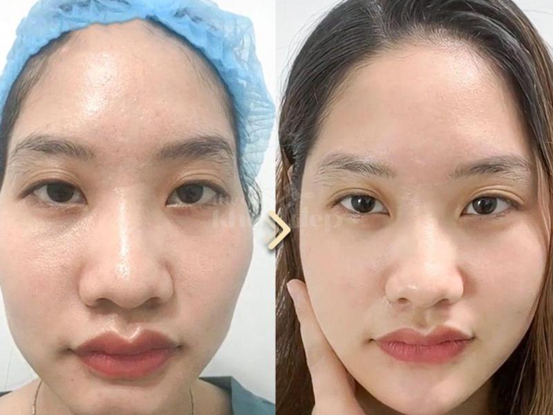 Tiêm má Baby – Giải pháp trẻ hóa gương mặt, khắc phục hóp má, mang lại nét đẹp căng đầy tự nhiên - 4/4