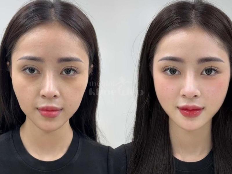 Tiêm má Baby cho nam & nữ U40–50: Giải pháp trẻ hóa, cân đối gương mặt - 3/4